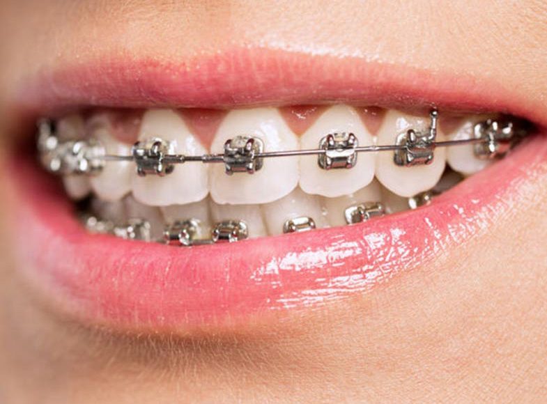 6 Possible Teeth Straightening Options