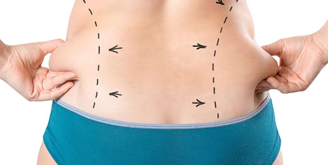 The Amazing Benefits of Liposuction