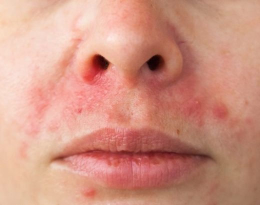 All you need to know about Contact Dermatitis