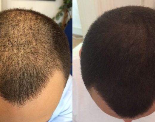 5 Benefits of Scalp Micropigmentation for Hair Loss