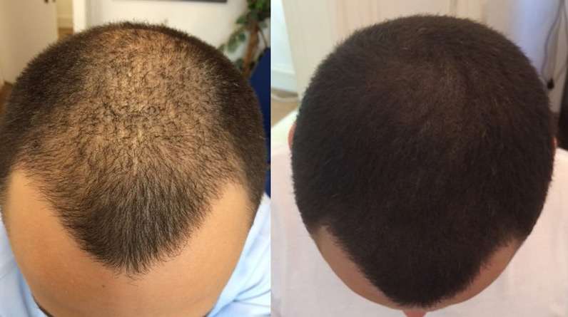5 Benefits of Scalp Micropigmentation for Hair Loss