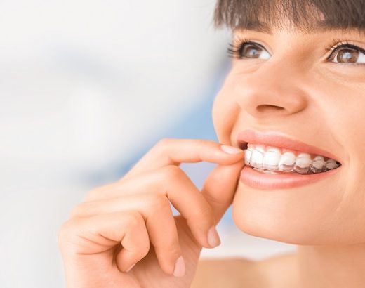 Reviewing the pros and cons of clear aligner treatment